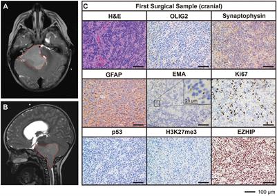 In vivo loss of tumorigenicity in a patient-derived orthotopic xenograft mouse model of ependymoma